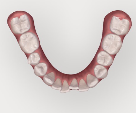 Appareil Dentaire Orthodontique Alignement Des Dents Soins - Temu  Switzerland