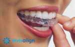 Centre dentaire Lancy - Les gouttières Invisalign®