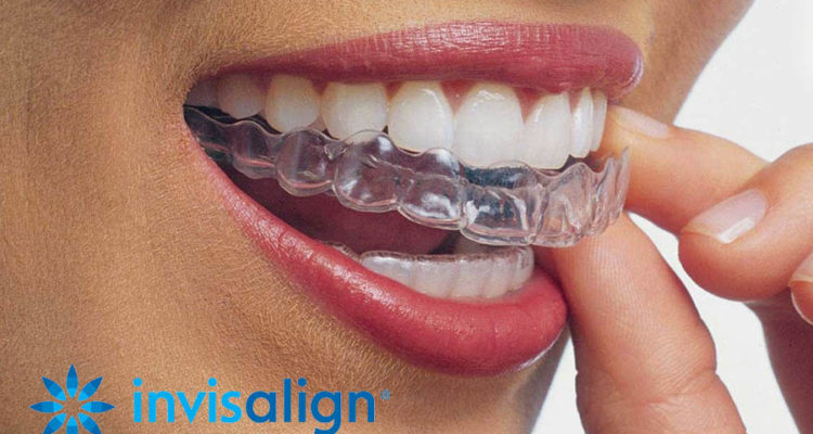 Centre dentaire Lancy - Les gouttières Invisalign®