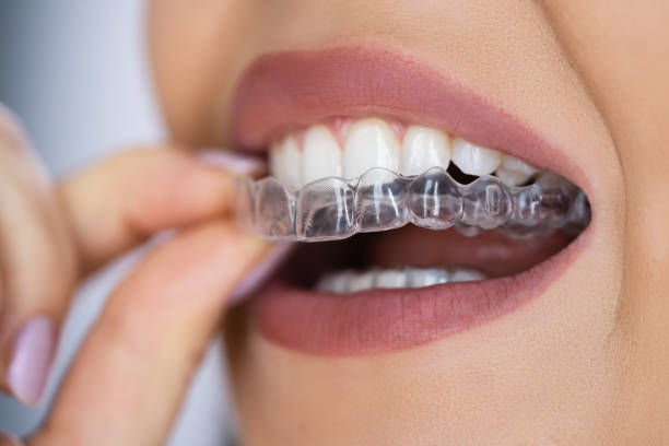 gouttière Invisalign